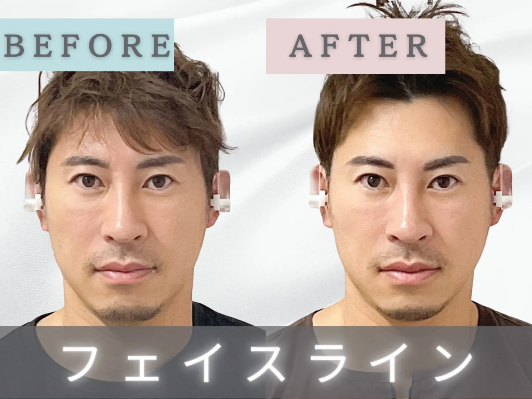 【新宿・代々木】男性のお客様|フェイスラインが気になる方!小顔矯正6回目・10回目の経過ビフォーアフター