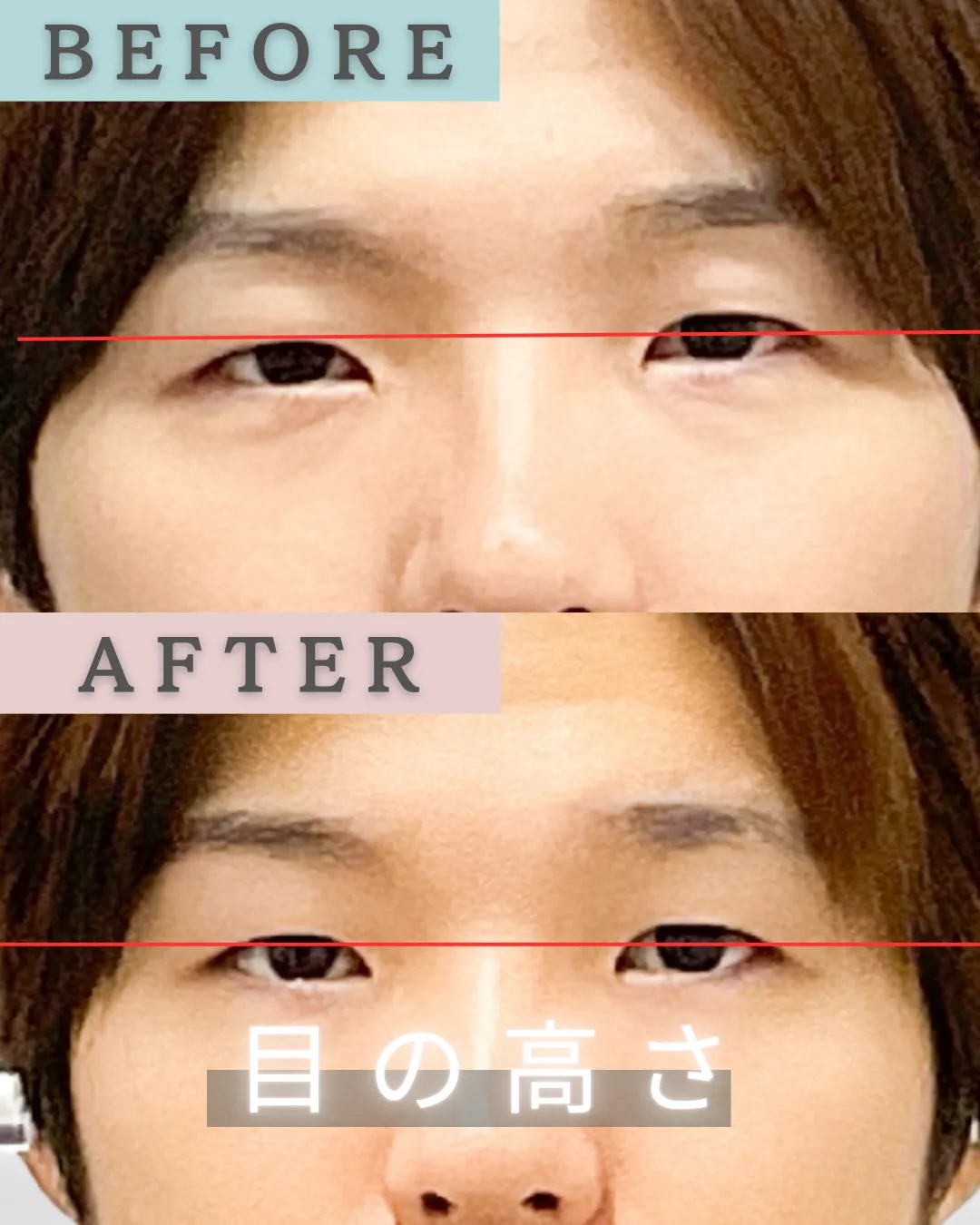 【新宿・代々木】目の左右差ailes式 before・after 新宿・食いしばり・骨盤矯正・小顔矯正・顎関節症・顔の左右差ならailesシンメトリー矯正院